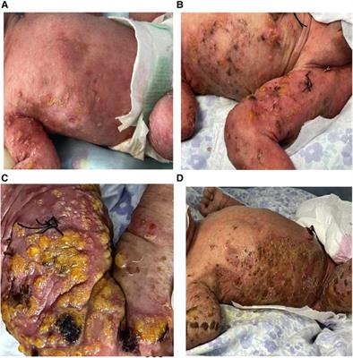 A case report of neonatal incontinentia pigmenti complicated by severe cerebrovascular lesions in one of the male monozygotic twins